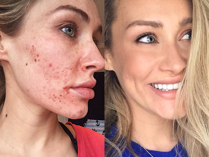 Laser Acne Treatment