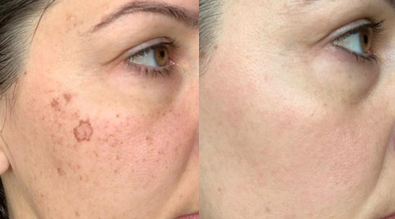 Laser Pigmentation Removal