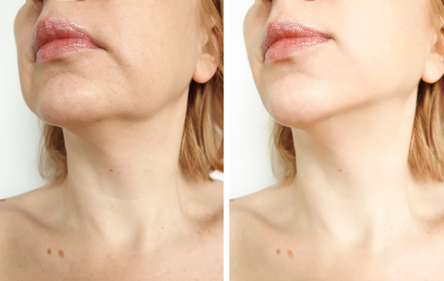 Laser Tightening