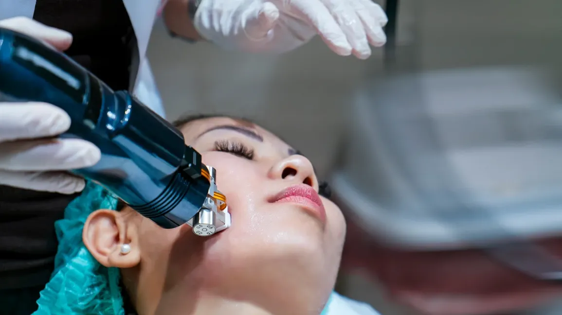 Full Face RF Microneedling